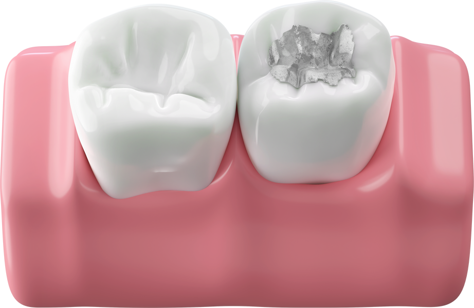Dental amalgam fillings